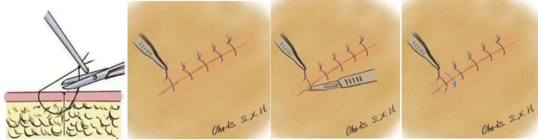 为什么要用皮肤缝合器【川骨知乎】缝合伤口用 “订书机”!？ 带您了解皮肤缝合器_https://www.jmylbn.com_新闻资讯_第13张