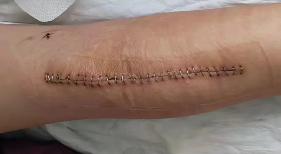 为什么要用皮肤缝合器【川骨知乎】缝合伤口用 “订书机”!？ 带您了解皮肤缝合器_https://www.jmylbn.com_新闻资讯_第11张