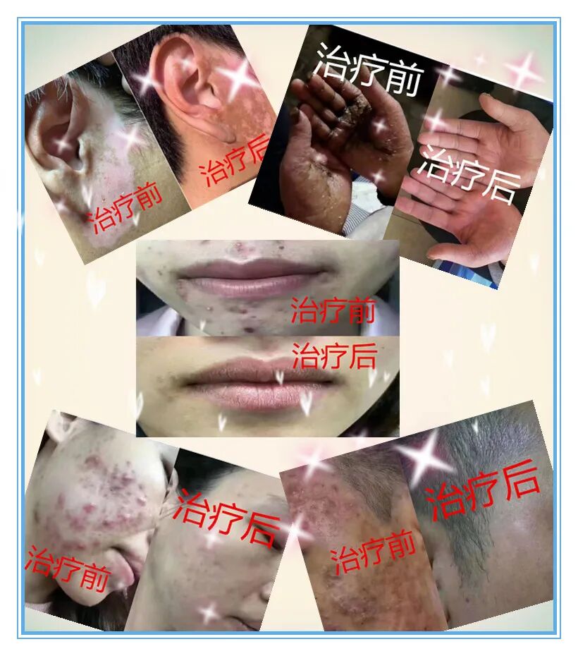 皮肤病克星：白癜风、斑秃、缠腰蛇、黄褐斑...