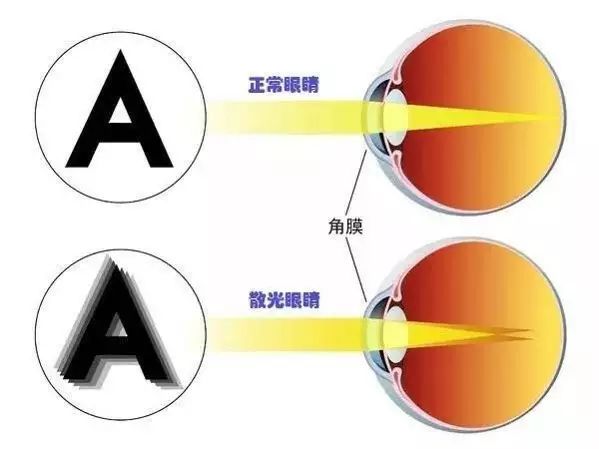 散光到底是什么？这一次终于说清楚了…