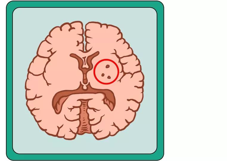 80%腦出血與這個疾病有關，出現這3個症狀趕緊就醫! 健康 第33張