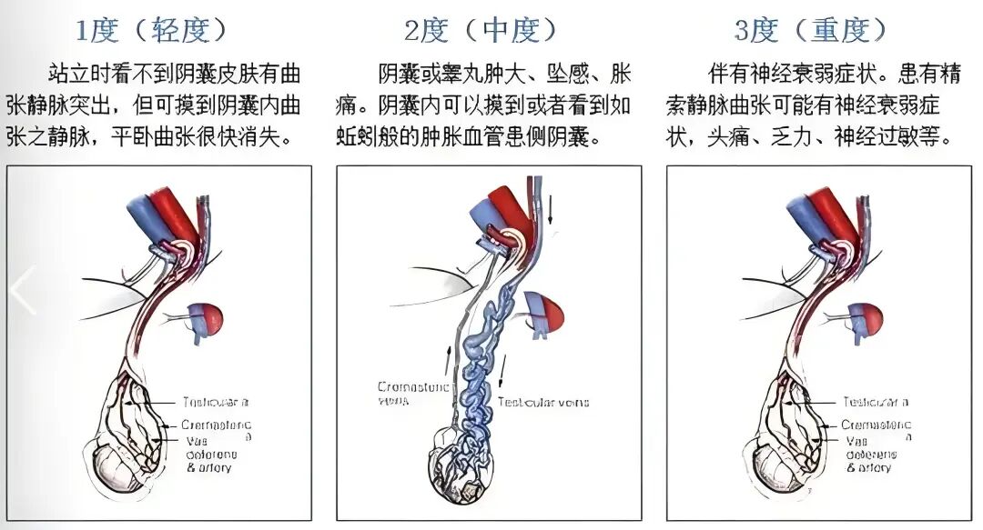 什么是显微镜手术健康科普｜显微镜下精索静脉高位结扎术_https://www.jmylbn.com_新闻资讯_第3张