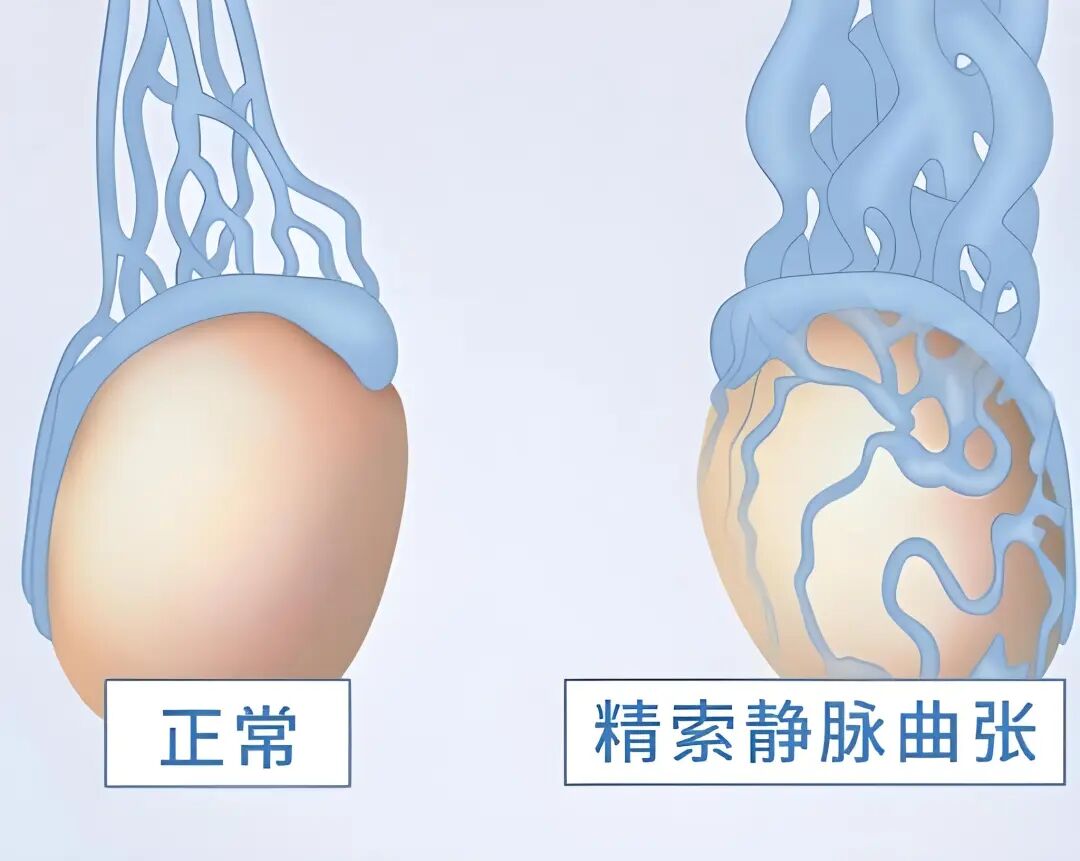 什么是显微镜手术健康科普｜显微镜下精索静脉高位结扎术_https://www.jmylbn.com_新闻资讯_第2张