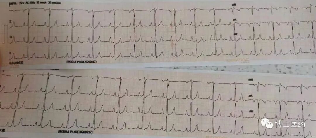 ecg导联脱落怎么办常见ECG导联连接异常分析_https://www.jmylbn.com_新闻资讯_第7张