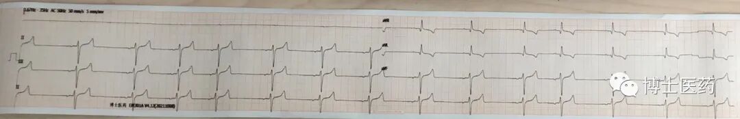 ecg导联脱落怎么办常见ECG导联连接异常分析_https://www.jmylbn.com_新闻资讯_第13张