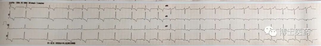 ecg导联脱落怎么办常见ECG导联连接异常分析_https://www.jmylbn.com_新闻资讯_第8张