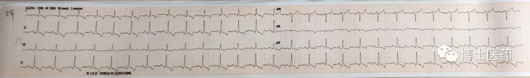 ecg导联脱落怎么办常见ECG导联连接异常分析_https://www.jmylbn.com_新闻资讯_第3张