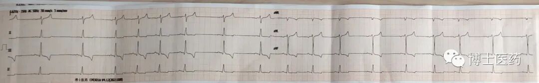 ecg导联脱落怎么办常见ECG导联连接异常分析_https://www.jmylbn.com_新闻资讯_第10张