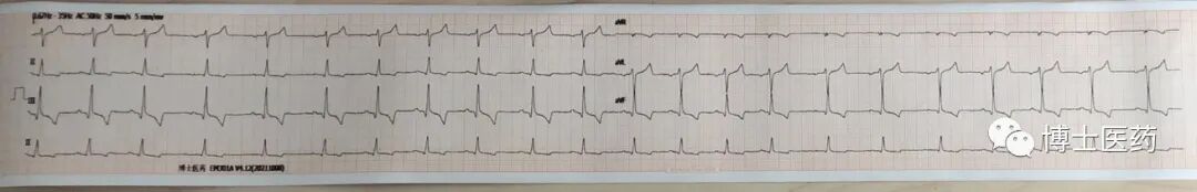 ecg导联脱落怎么办常见ECG导联连接异常分析_https://www.jmylbn.com_新闻资讯_第6张
