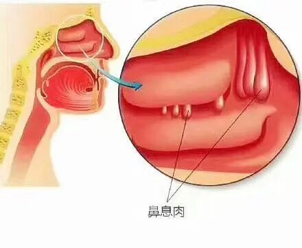 鼻塞不一定是鼻炎，也可能是鼻息肉，最好早发现早调理！