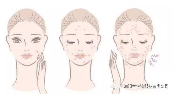 L.C朗格罕氏细胞修复剂