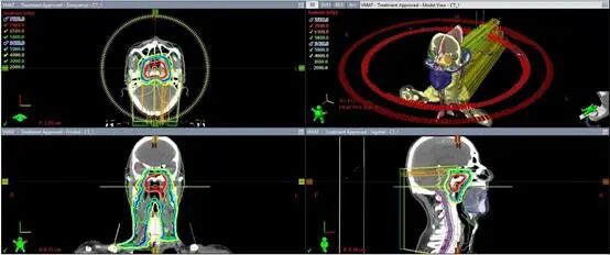 放疗计划系统有哪些肿瘤放疗“艺术家”的“画布” ——放射治疗计划系统简介_https://www.jmylbn.com_新闻资讯_第14张