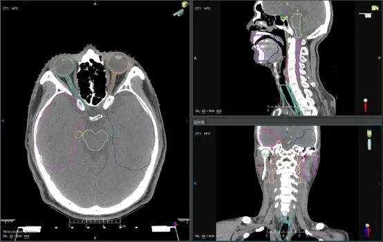 放疗计划系统有哪些肿瘤放疗“艺术家”的“画布” ——放射治疗计划系统简介_https://www.jmylbn.com_新闻资讯_第13张