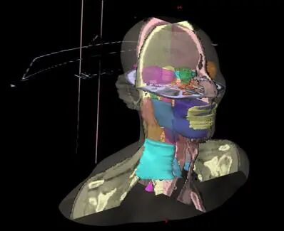 放疗计划系统有哪些肿瘤放疗“艺术家”的“画布” ——放射治疗计划系统简介_https://www.jmylbn.com_新闻资讯_第12张