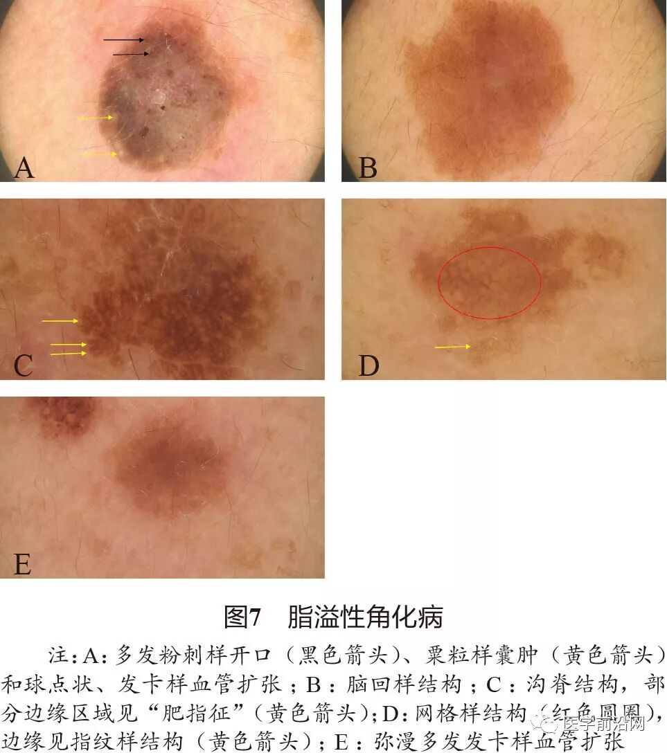 面部常见皮肤病皮肤镜诊断专家共识转载