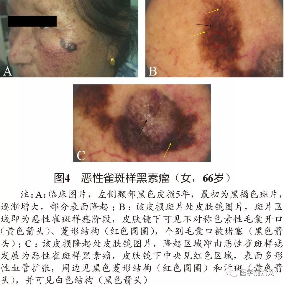 169恶性雀斑样痣/黑素瘤69恶性雀斑样痣(len tigo maligna,lm)和