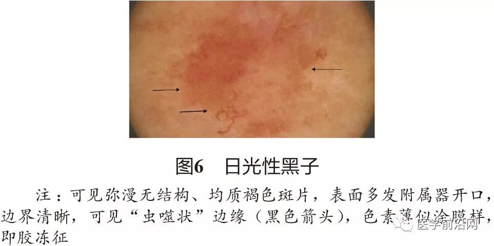 169日光性黑子69又称日光性雀斑样痣(solor lentigo,sl)或老年性