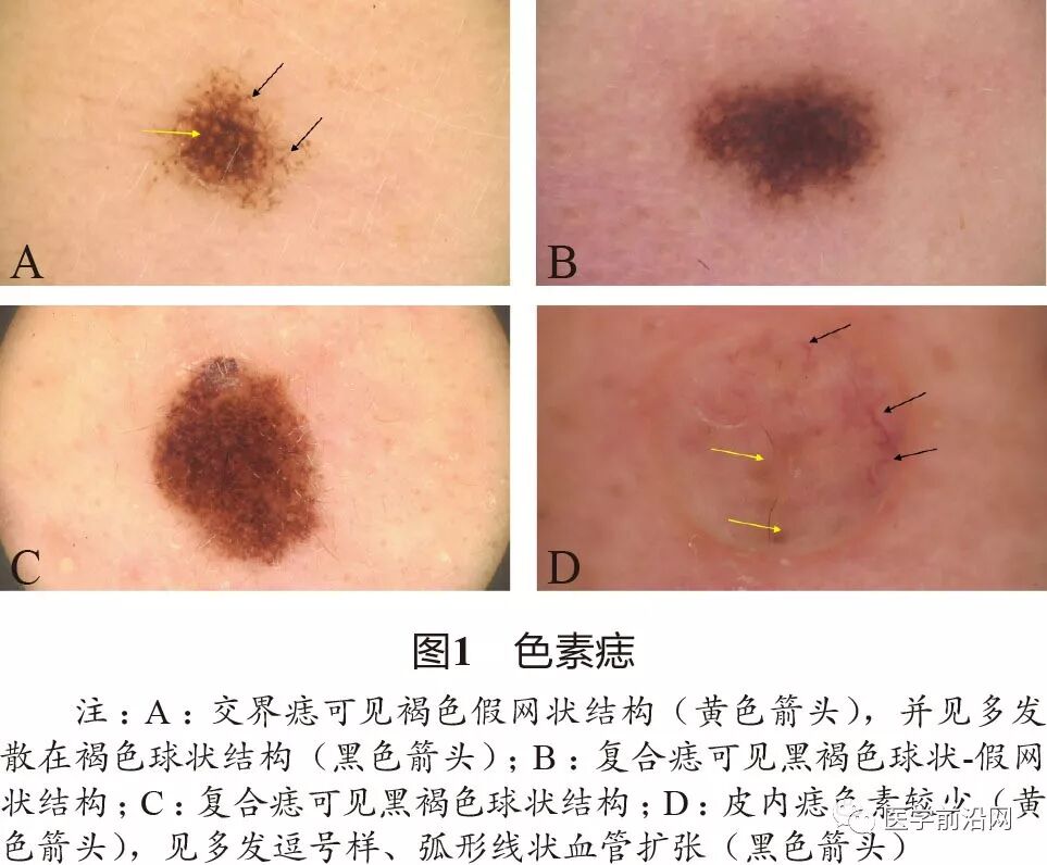 痣多表现为黑褐色斑疹或轻度隆起的丘疹,病理上多为交界痣或复合痣