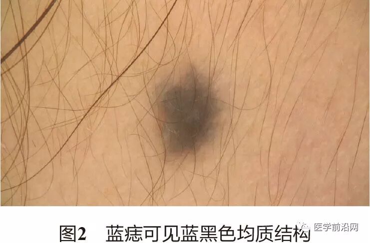 面部常见皮肤病皮肤镜诊断专家共识转载