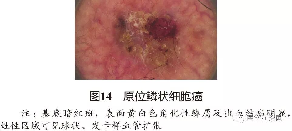 排列的褐色/灰色小点,团块征,双边征均为诊断色素性鲍温病的重要依据