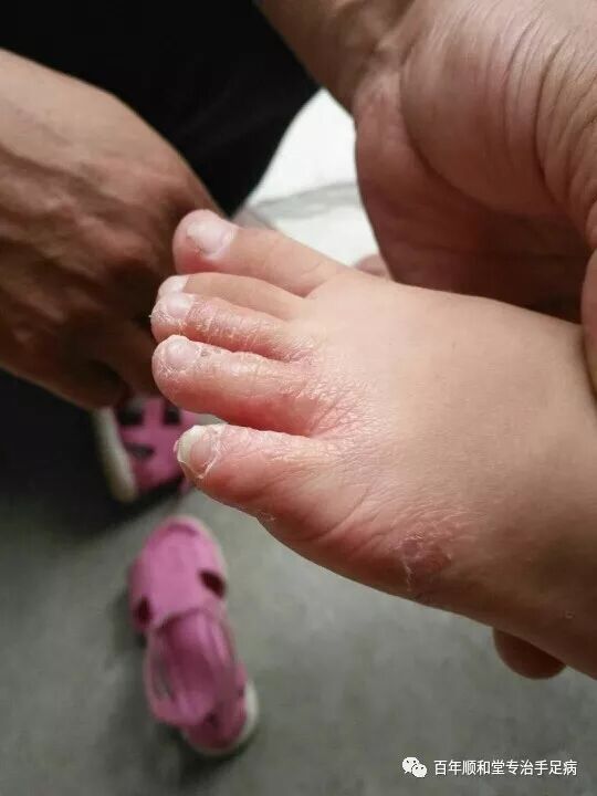 ◆儿童穿大人鞋子当心感染足癣