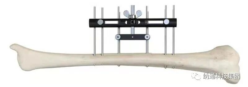 骨折固定有哪些产品正天外固定支架产品，微创治疗多种创伤骨折_https://www.jmylbn.com_新闻资讯_第15张