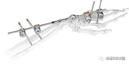 骨折固定有哪些产品正天外固定支架产品，微创治疗多种创伤骨折_https://www.jmylbn.com_新闻资讯_第23张