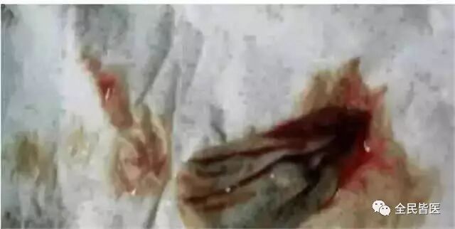 有个医生拿了一颗我们权健egf抑菌泡腾片,原名"洁净宝"去化验,发现其