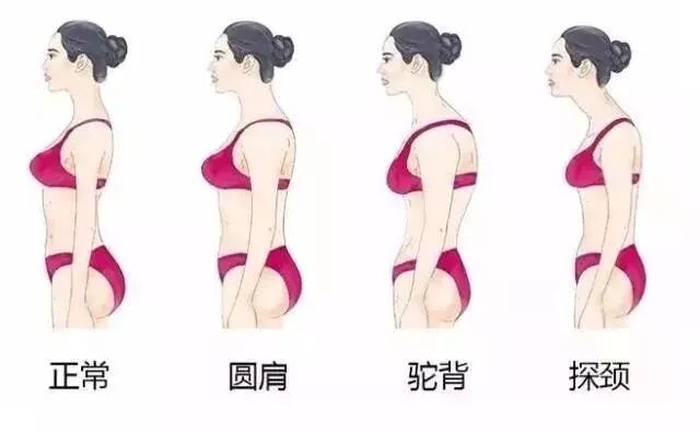 早期只是圆肩,也叫含胸,看起来像轻微的驼背一样,是指双肩向前弯曲