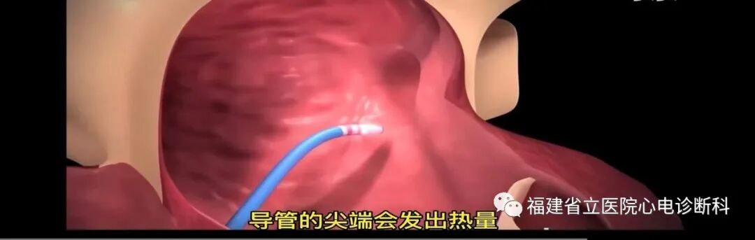 “快慢综合征”与“慢快综合征”的区别与联系