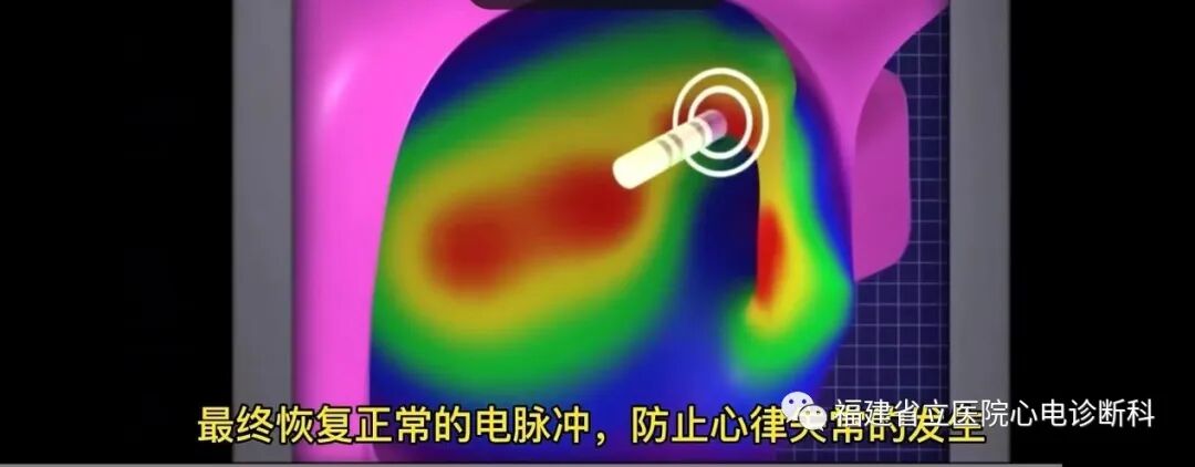 “快慢综合征”与“慢快综合征”的区别与联系