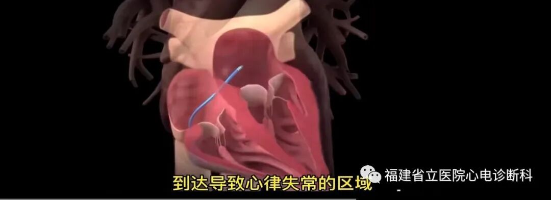 “快慢综合征”与“慢快综合征”的区别与联系