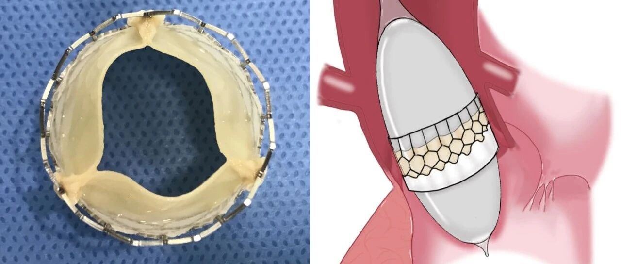 临床转化的这项“中国制造”，让主动脉球囊扩张瓣膜更贴近“中国心”