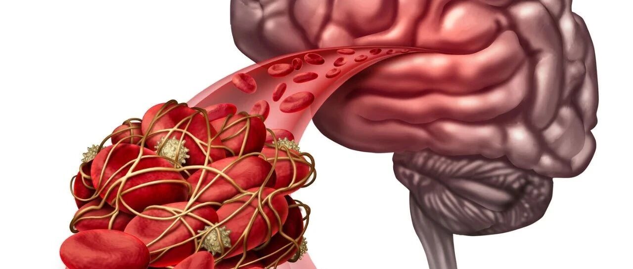 脑血管病新研发热点：脑血流自动调节功能