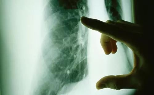 【臨床乾貨】肺癌轉移怎麼辦？專家：強攻不如巧控，全面評估很重要 健康 第3張