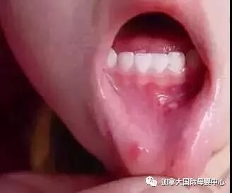 遇上宝宝口臭 口腔溃疡 该怎么办 加拿大abc加籍宝贝月子中心 微信公众号文章阅读 Wemp