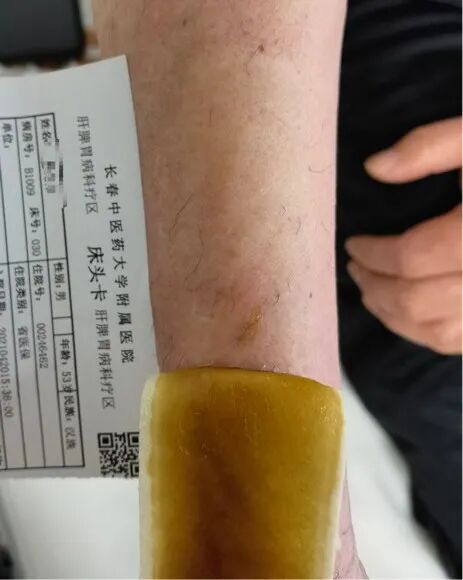 怎么贴好输液贴【名医名科】长期静脉输液的好搭档：水凝胶豆黄消炎贴_https://www.jmylbn.com_新闻资讯_第5张