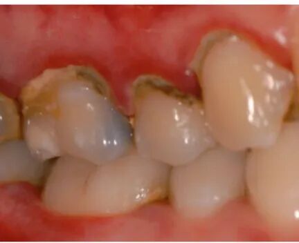 什么是口腔修复膜【名医名科】口腔中心帮您解决牙菌斑生物膜的困扰_https://www.jmylbn.com_新闻资讯_第7张