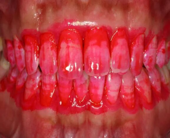 什么是口腔修复膜【名医名科】口腔中心帮您解决牙菌斑生物膜的困扰_https://www.jmylbn.com_新闻资讯_第3张