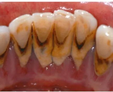 什么是口腔修复膜【名医名科】口腔中心帮您解决牙菌斑生物膜的困扰_https://www.jmylbn.com_新闻资讯_第8张