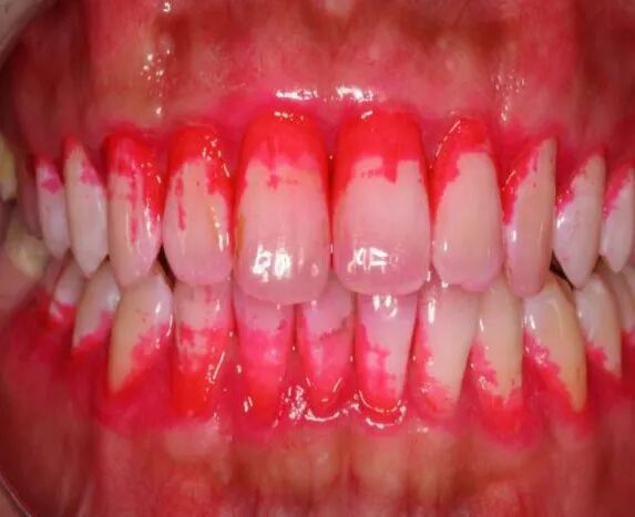 什么是口腔修复膜【名医名科】口腔中心帮您解决牙菌斑生物膜的困扰_https://www.jmylbn.com_新闻资讯_第4张