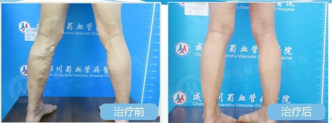 医用弹力袜用什么洗来了！医用弹力袜的使用方法及注意事项_https://www.jmylbn.com_新闻资讯_第3张