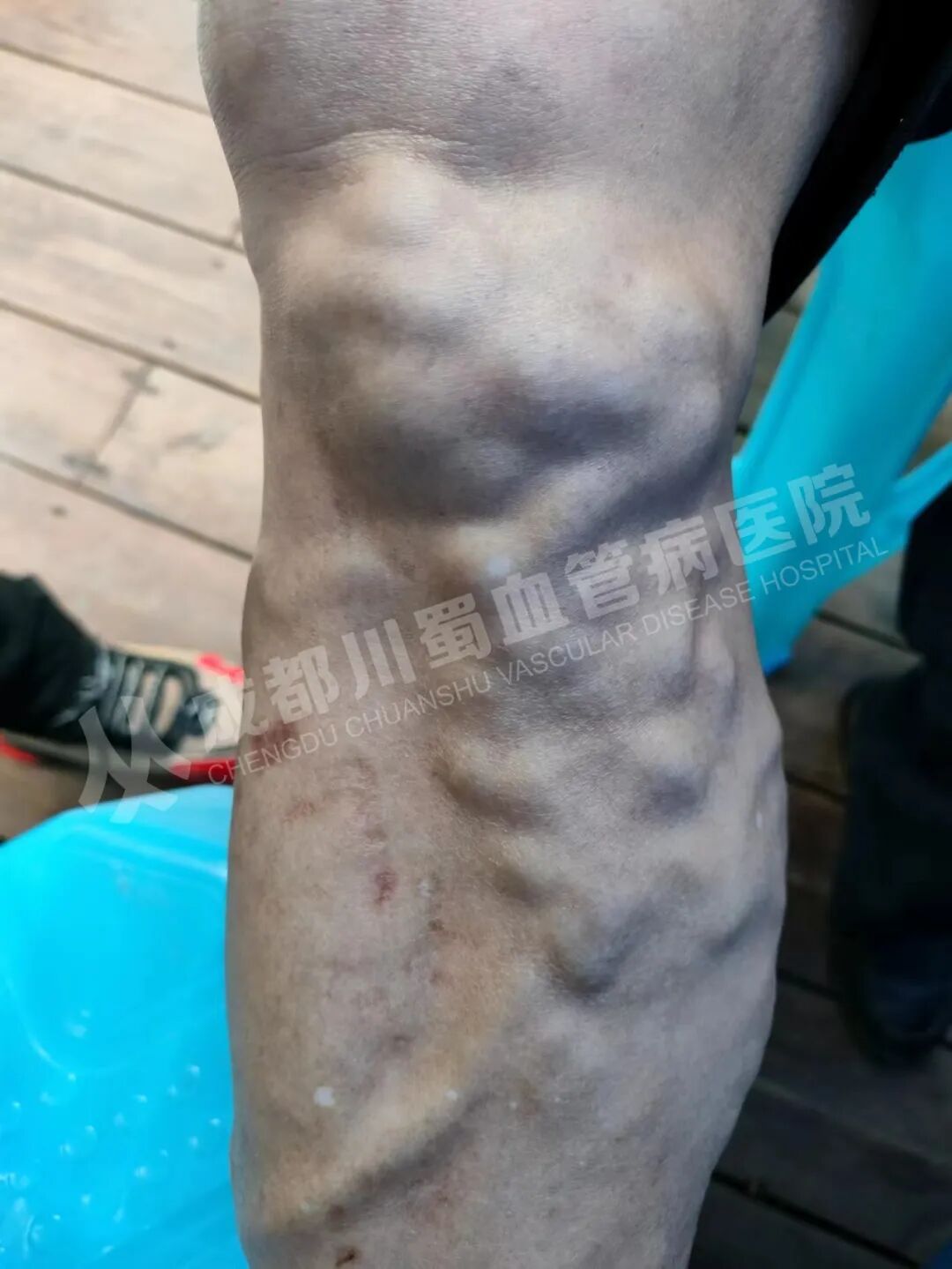 天气变冷，腿上静脉曲张问题不可小觑！