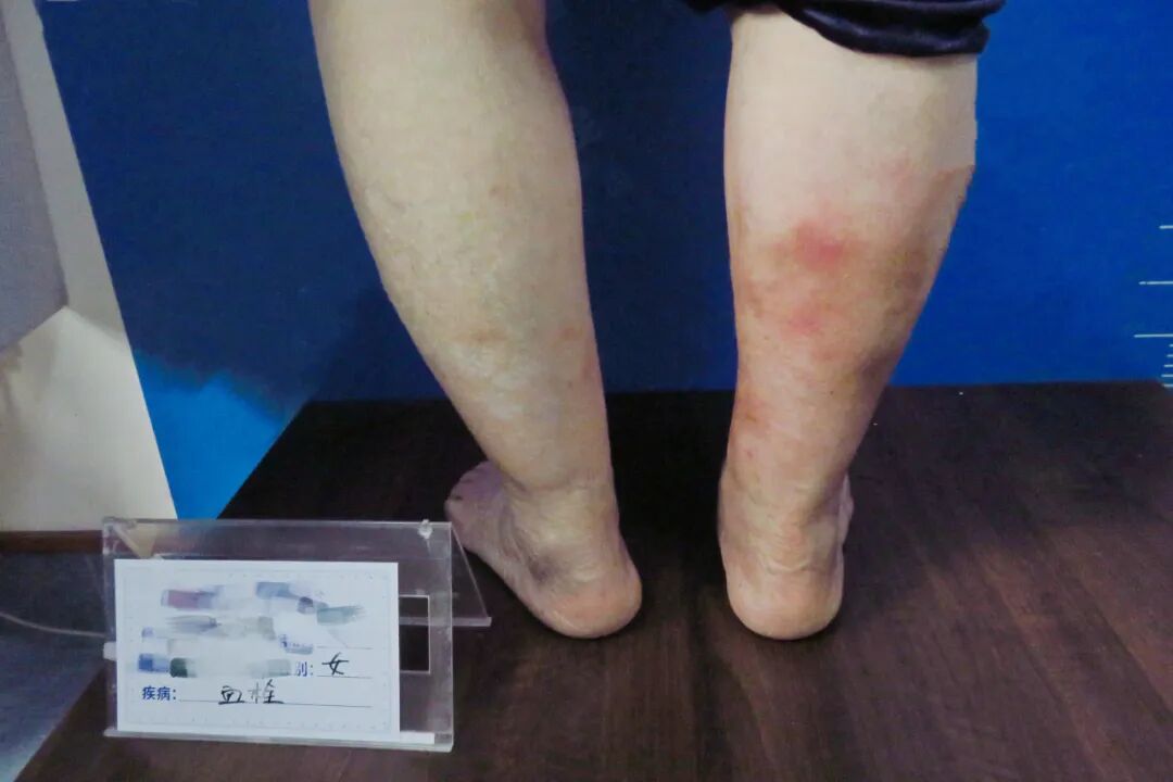 医用弹力袜用什么洗来了！医用弹力袜的使用方法及注意事项_https://www.jmylbn.com_新闻资讯_第6张