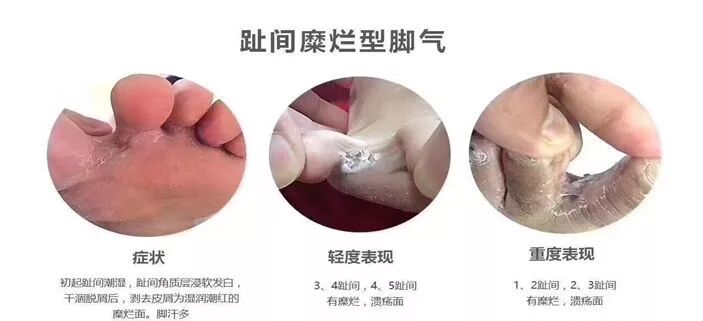 脚气 香港脚 足癣 免费体检治疗啦 五邑中医院皮肤科 微信公众号文章阅读 Wemp