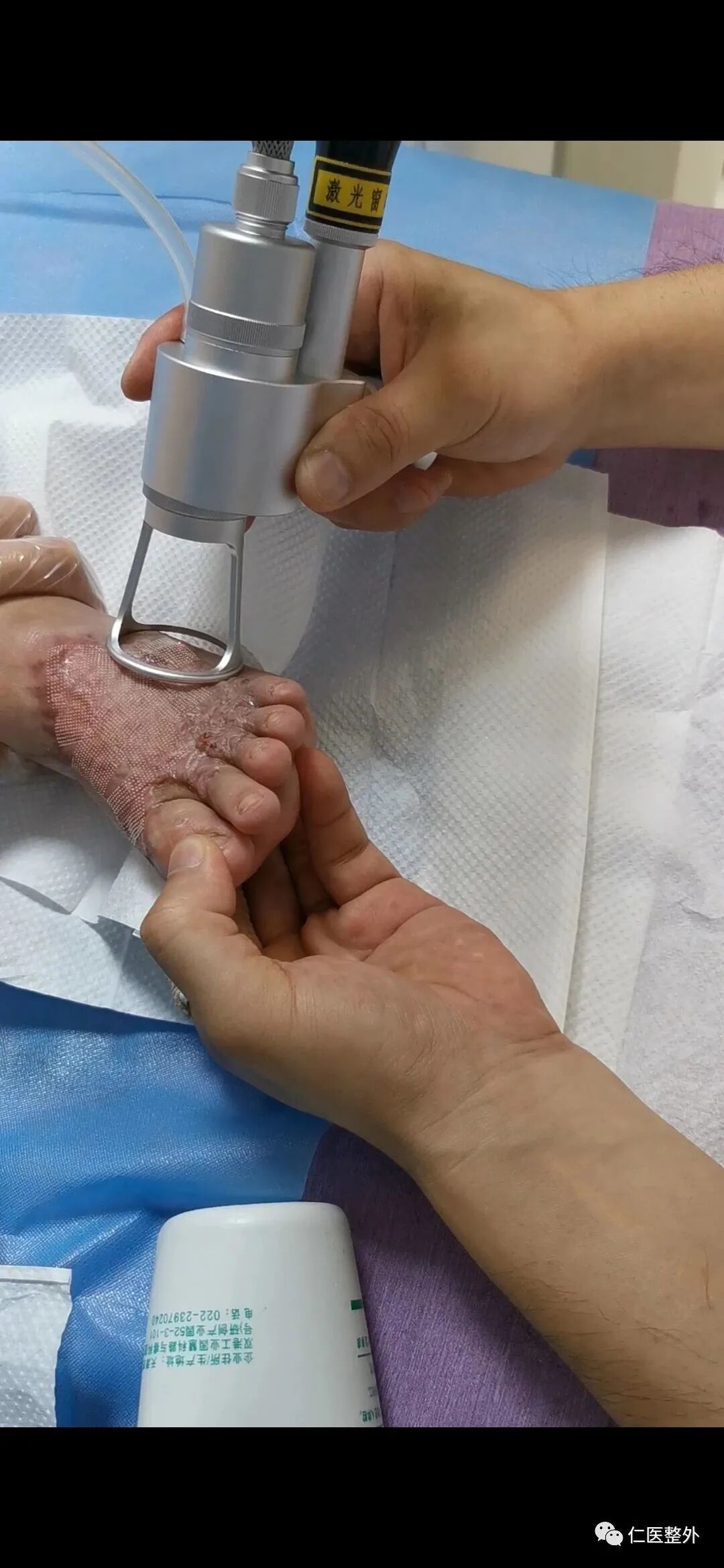 二氧化碳(co2)激光治疗是什么超脉冲二氧化碳点阵激光治疗_https://www.jmylbn.com_新闻资讯_第1张