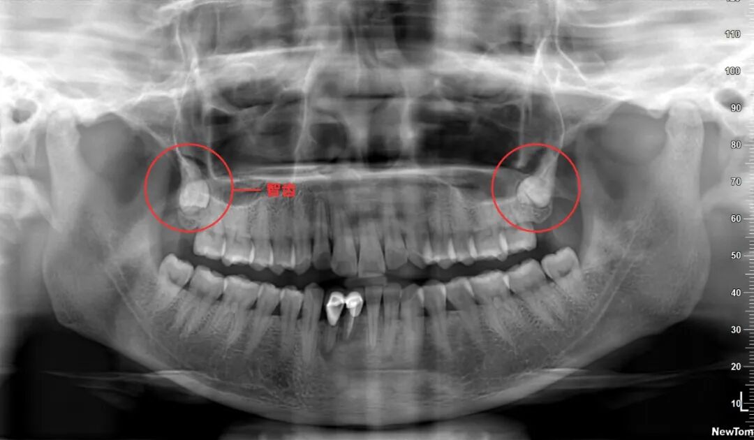 口腔ct怎么看拍了牙片怎么看？一分钟教会你快速看懂_https://www.jmylbn.com_新闻资讯_第7张