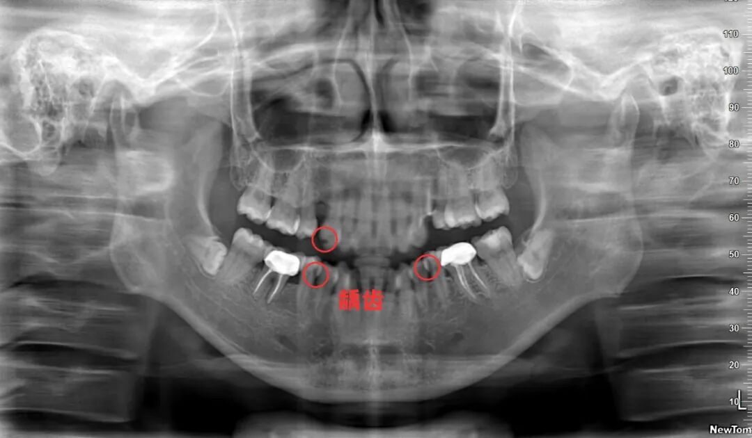 口腔ct怎么看拍了牙片怎么看？一分钟教会你快速看懂_https://www.jmylbn.com_新闻资讯_第9张