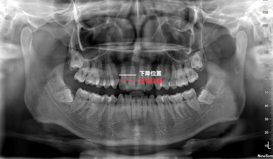 口腔ct怎么看拍了牙片怎么看？一分钟教会你快速看懂_https://www.jmylbn.com_新闻资讯_第11张