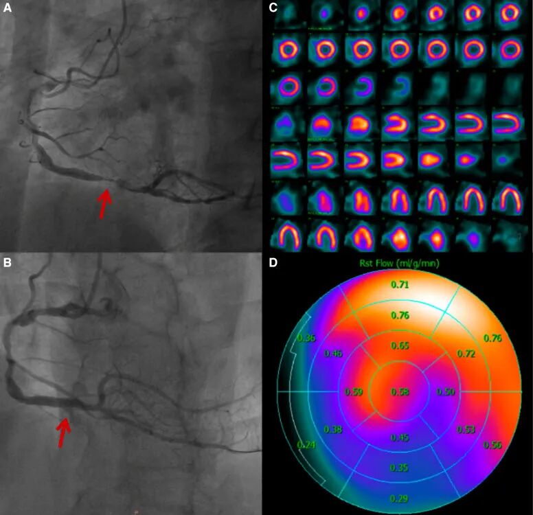 d-spect怎么检查【发布】Front. Cardiovasc. Med. ｜尚华教授团队：D-SPECT测定静息MBF值对STEMI患者诊断价值_https://www.jmylbn.com_新闻资讯_第9张